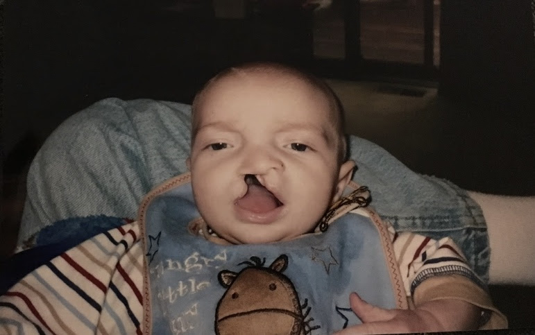 My little brother when he was about 2 months old before his first surgery. His surgeon said that this was the widest cleft lip and palette he has seen.